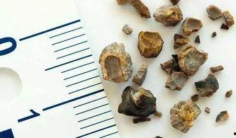 肾结石吃梨瓜好吗,缓解症状助康复